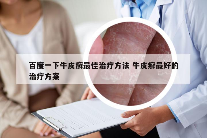 百度一下牛皮癣最佳治疗方法 牛皮癣最好的治疗方案