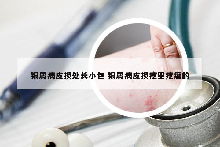 银屑病皮损处长小包 银屑病皮损疙里疙瘩的