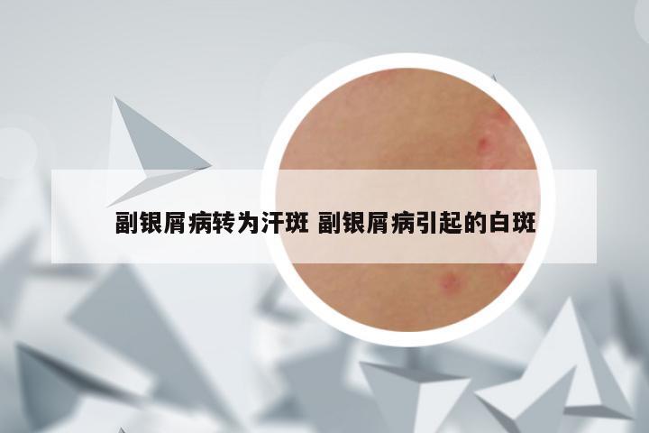 副银屑病转为汗斑 副银屑病引起的白斑