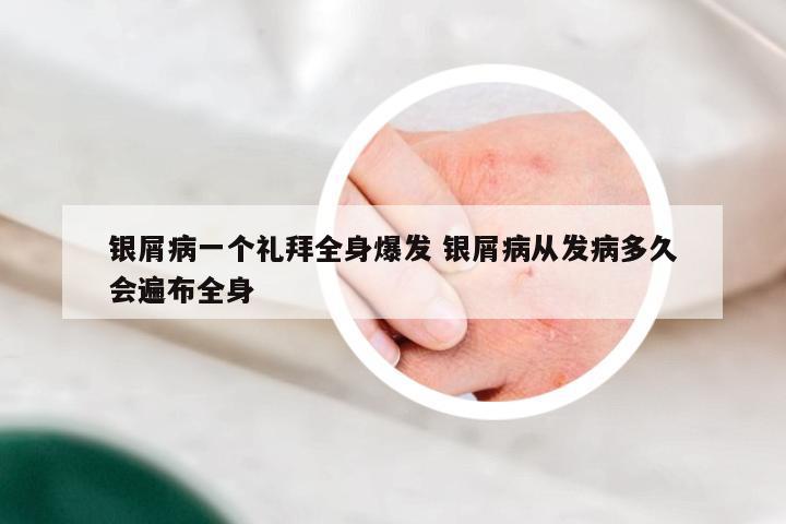 银屑病一个礼拜全身爆发 银屑病从发病多久会遍布全身
