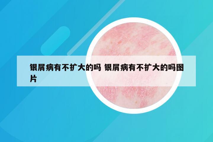 银屑病有不扩大的吗 银屑病有不扩大的吗图片