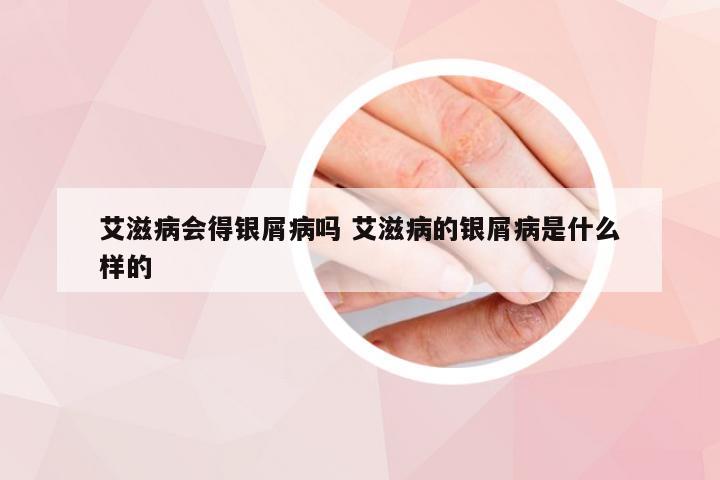 艾滋病会得银屑病吗 艾滋病的银屑病是什么样的