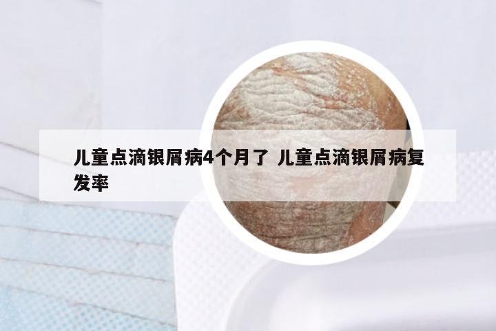 儿童点滴银屑病4个月了 儿童点滴银屑病复发率