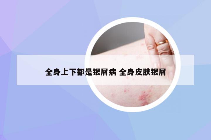 全身上下都是银屑病 全身皮肤银屑