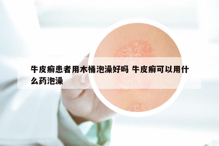 牛皮癣患者用木桶泡澡好吗 牛皮癣可以用什么药泡澡