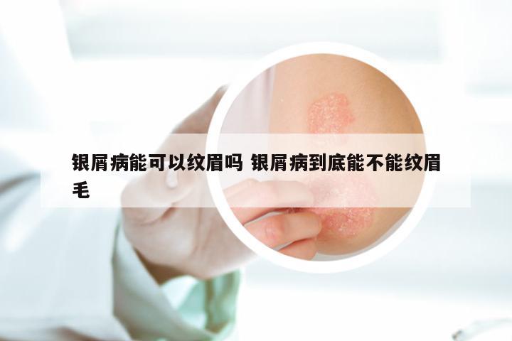 银屑病能可以纹眉吗 银屑病到底能不能纹眉毛
