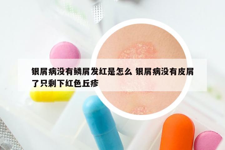 银屑病没有鳞屑发红是怎么 银屑病没有皮屑了只剩下红色丘疹