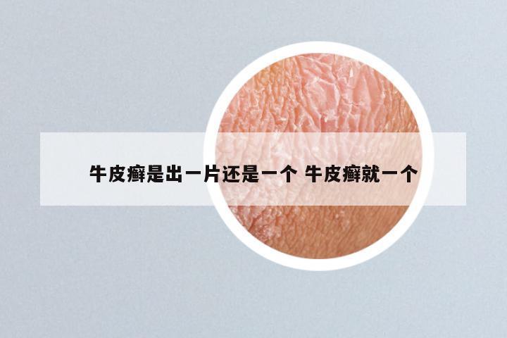 牛皮癣是出一片还是一个 牛皮癣就一个