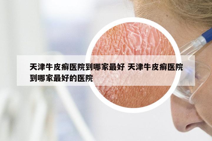 天津牛皮癣医院到哪家最好 天津牛皮癣医院到哪家最好的医院