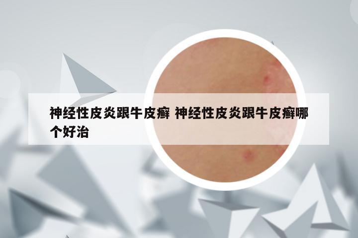 神经性皮炎跟牛皮癣 神经性皮炎跟牛皮癣哪个好治
