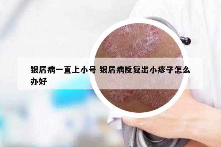 银屑病一直上小号 银屑病反复出小疹子怎么办好