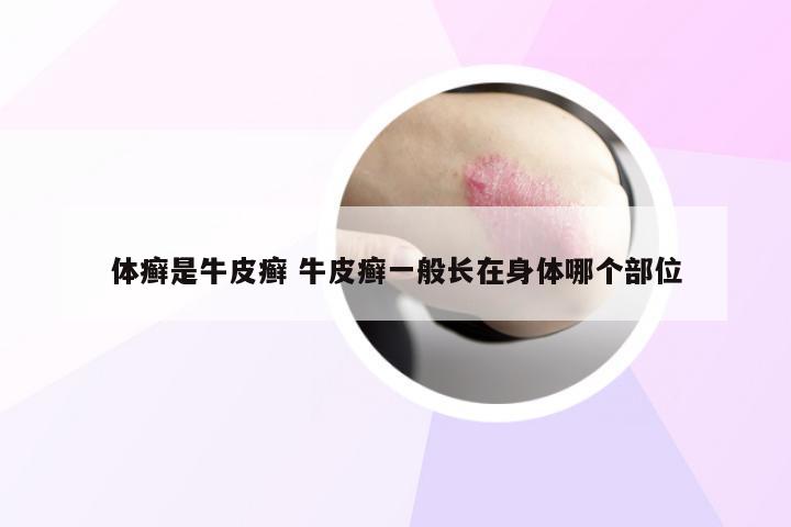 体癣是牛皮癣 牛皮癣一般长在身体哪个部位
